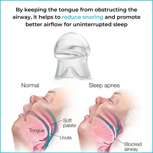 Benefits of using Snoreshield Anti-snoring Device